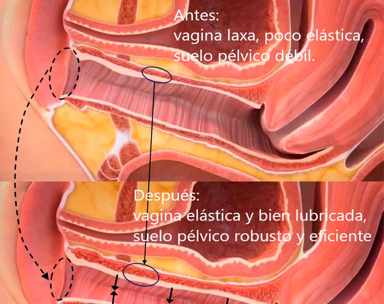 rejuvenecimiento-vaginal-ginecologo-almeria